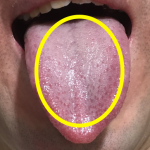 口臭の大敵・舌苔の取り方！タオルで簡単除去！舌を傷つけない（白色・ぜったい）